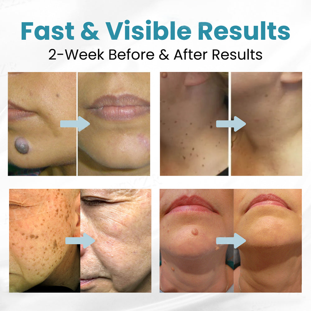 BBOJI™ Non-invasive Mole and Wart Removal Laser Pen