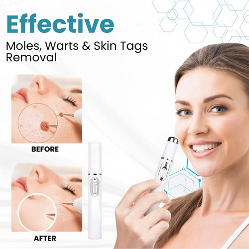 BBOJI™ Non-invasive Mole and Wart Removal Laser Pen