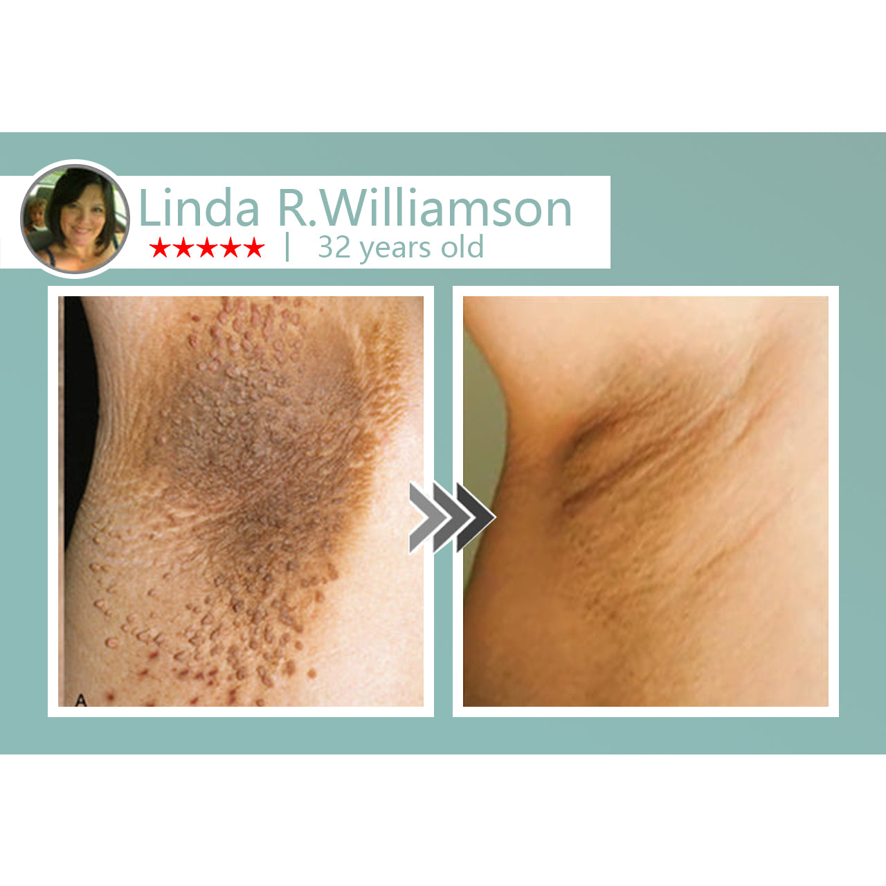 🌈LOVILDS® MicroNeedle Botanic Skin Tag Removal Patch 🇺🇸 Made in the USA
