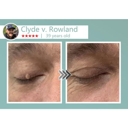 🌈LOVILDS® MicroNeedle Botanic Skin Tag Removal Patch 🇺🇸 Made in the USA